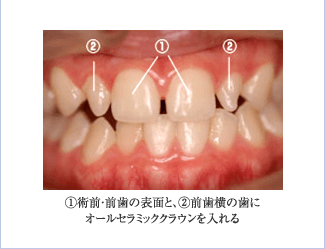 ①術前・前歯の表面と、②前歯横の歯にオールセラミッククラウンを入れる
