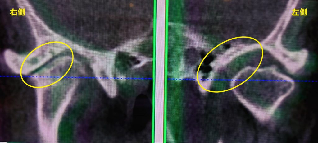 顎関節CTの前頭断面