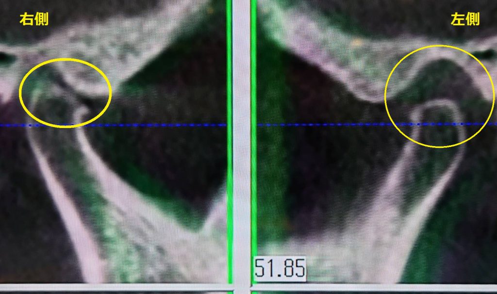 顎関節CTの矢状断面